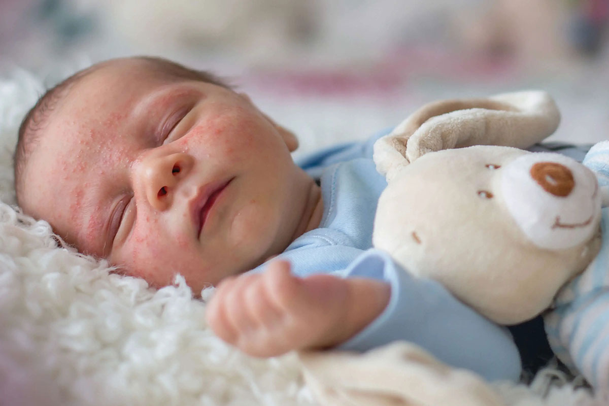 آیا شیر مادر آکنه نوزادان را از بین می‌برد؟