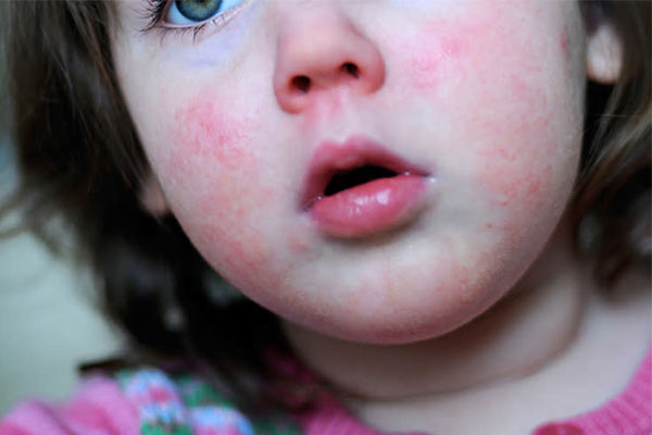 چرا توجه به پوست و حساسیت های پوستی کودکان مهم است؟